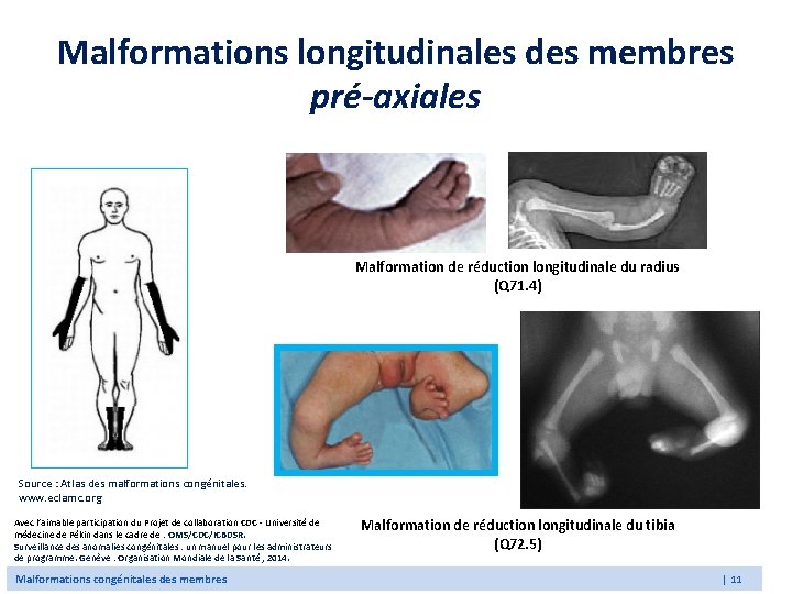 Malformations longitudinales des membres pré-axiales Malformation de réduction longitudinale du radius (Q 71. 4)