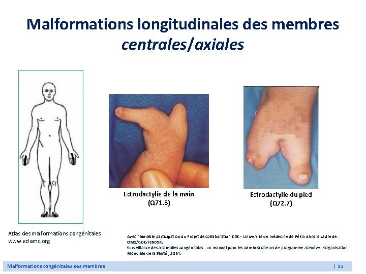 Malformations longitudinales des membres centrales/axiales Ectrodactylie de la main (Q 71. 6) Atlas des