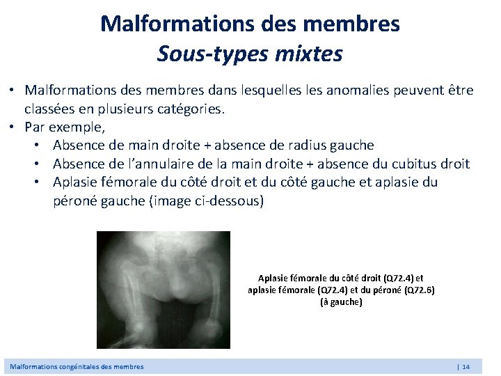 Malformations des membres Sous-types mixtes • Malformations des membres dans lesquelles anomalies peuvent être