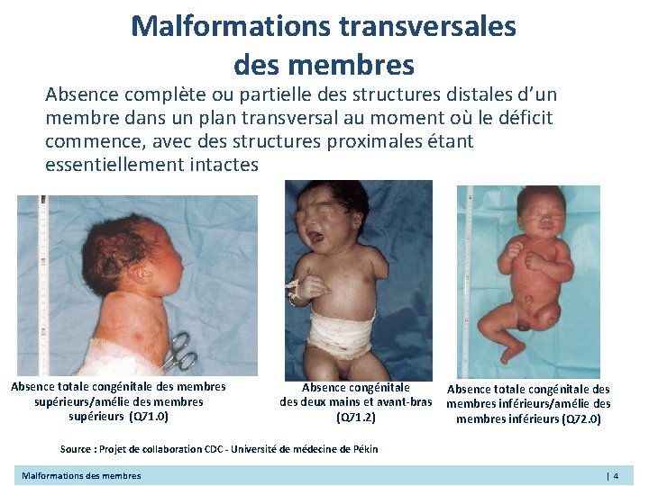 Malformations transversales des membres Absence complète ou partielle des structures distales d’un membre dans