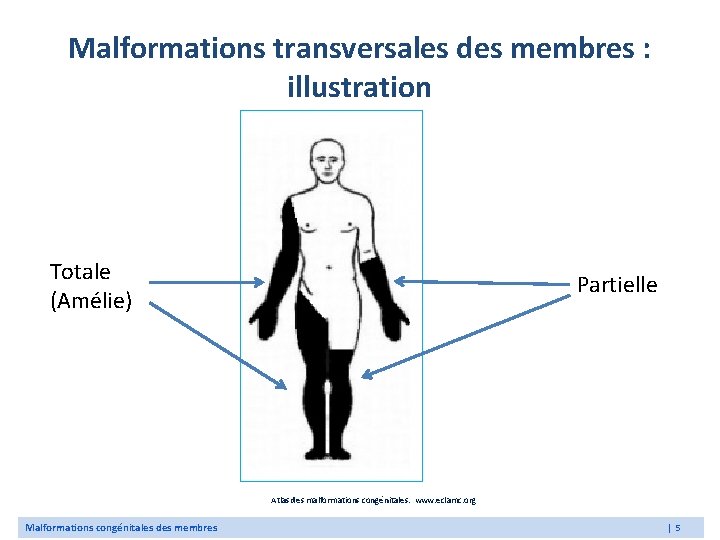 Malformations transversales des membres : illustration Totale (Amélie) Partielle Atlas des malformations congénitales. www.