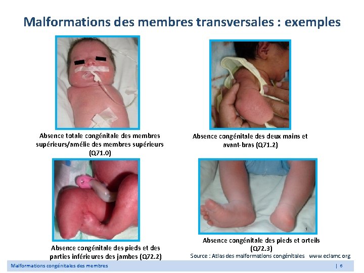 Malformations des membres transversales : exemples Absence totale congénitale des membres supérieurs/amélie des membres