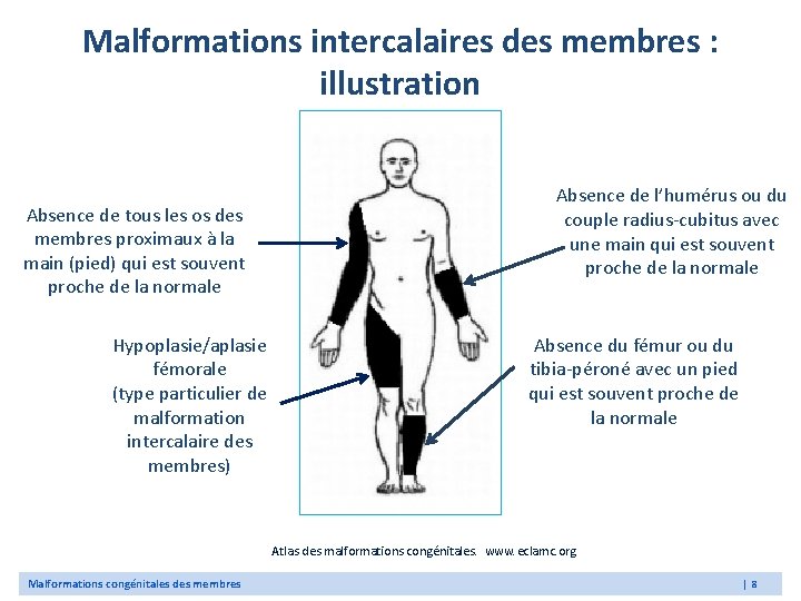 Malformations intercalaires des membres : illustration Absence de tous les os des membres proximaux