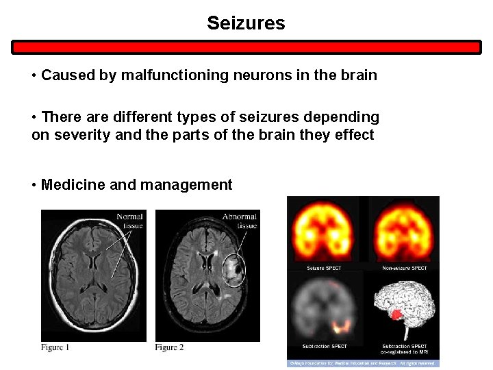Seizures • Caused by malfunctioning neurons in the brain • There are different types Seizures • Caused by malfunctioning neurons in the brain • There are different types