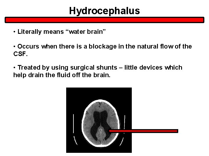 Hydrocephalus • Literally means “water brain” • Occurs when there is a blockage in Hydrocephalus • Literally means “water brain” • Occurs when there is a blockage in