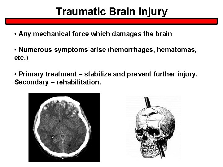 Traumatic Brain Injury • Any mechanical force which damages the brain • Numerous symptoms Traumatic Brain Injury • Any mechanical force which damages the brain • Numerous symptoms