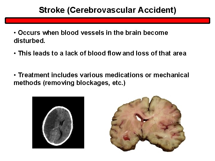 Stroke (Cerebrovascular Accident) • Occurs when blood vessels in the brain become disturbed. • Stroke (Cerebrovascular Accident) • Occurs when blood vessels in the brain become disturbed. •