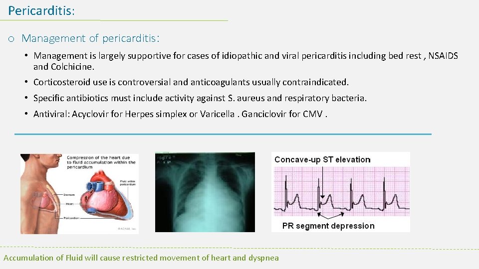Pericarditis: o Management of pericarditis: • Management is largely supportive for cases of idiopathic