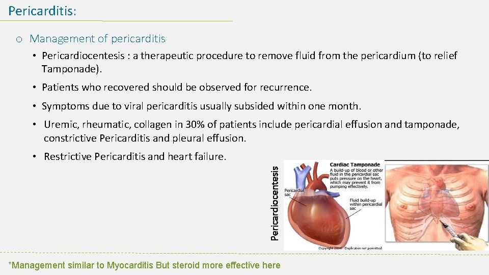 Pericarditis: o Management of pericarditis • Pericardiocentesis : a therapeutic procedure to remove fluid