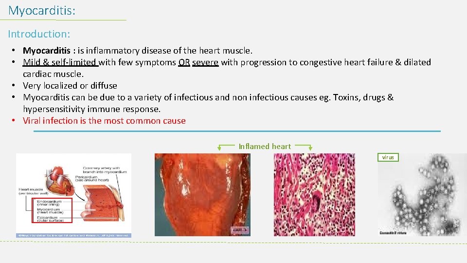 Myocarditis: Introduction: • Myocarditis : is inflammatory disease of the heart muscle. • Mild