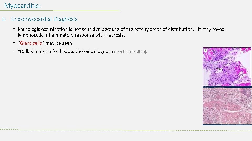 Myocarditis: o Endomyocardial Diagnosis • Pathologic examination is not sensitive because of the patchy