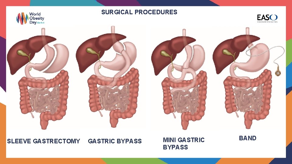 SURGICAL PROCEDURES SLEEVE GASTRECTOMY GASTRIC BYPASS MINI GASTRIC BYPASS BAND 