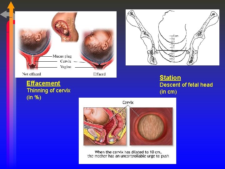 Effacement Thinning of cervix (in %) Station Descent of fetal head (in cm) 