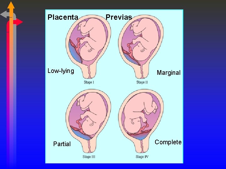 Placenta Previas Low-lying Marginal Partial Complete 
