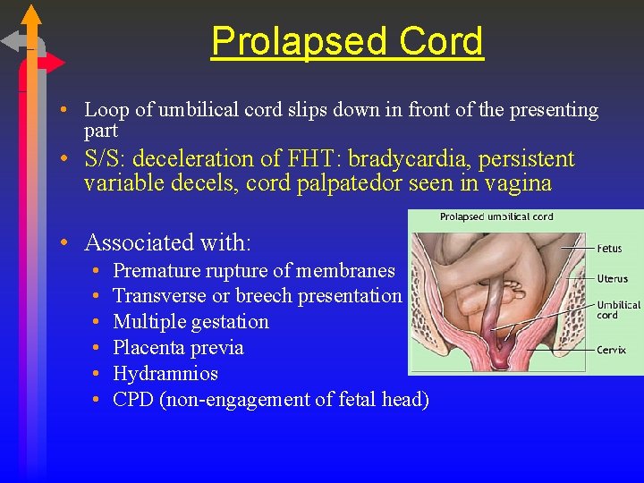 Prolapsed Cord • Loop of umbilical cord slips down in front of the presenting