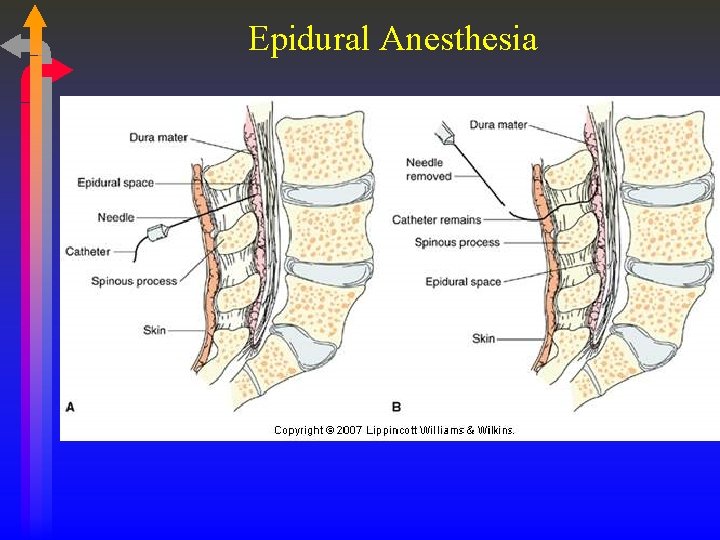 Epidural Anesthesia 