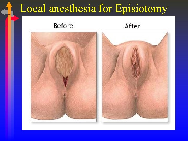 Local anesthesia for Episiotomy 
