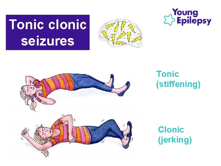 Tonic clonic seizures Tonic (stiffening) Clonic (jerking) 