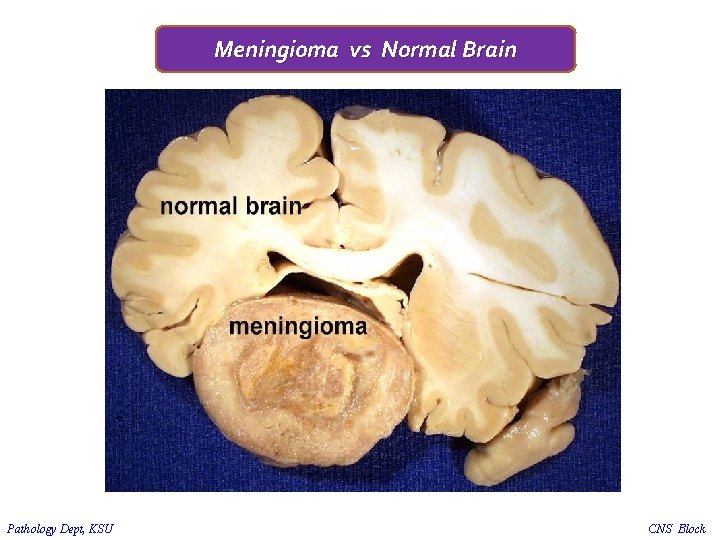 Meningioma vs Normal Brain Pathology Dept, KSU CNS Block 