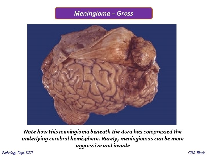 Meningioma – Gross Note how this meningioma beneath the dura has compressed the underlying