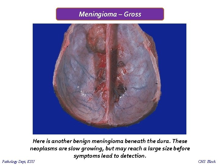 Meningioma – Gross Here is another benign meningioma beneath the dura. These neoplasms are