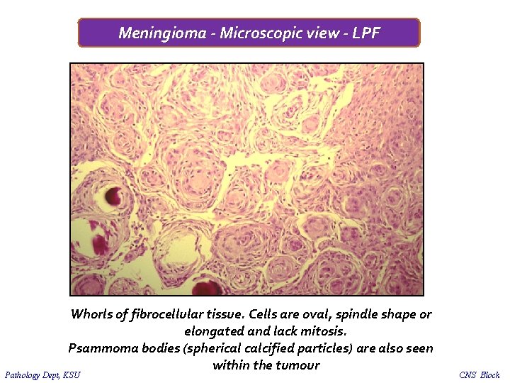 Meningioma - Microscopic view - LPF Whorls of fibrocellular tissue. Cells are oval, spindle