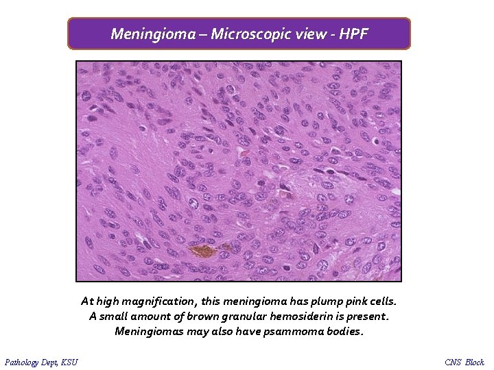 Meningioma – Microscopic view - HPF At high magnification, this meningioma has plump pink