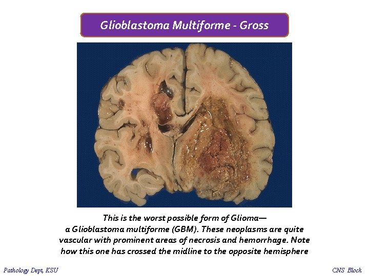 Glioblastoma Multiforme - Gross This is the worst possible form of Glioma— a Glioblastoma