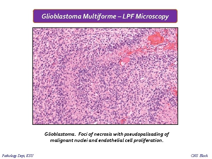 Glioblastoma Multiforme – LPF Microscopy Glioblastoma. Foci of necrosis with pseudopalisading of malignant nuclei