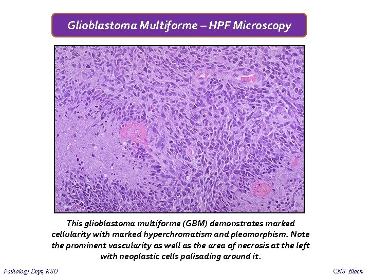 Glioblastoma Multiforme – HPF Microscopy This glioblastoma multiforme (GBM) demonstrates marked cellularity with marked