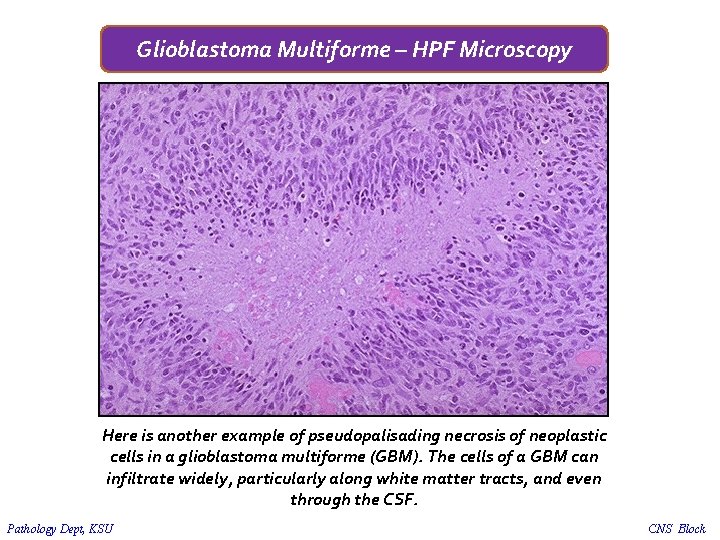 Glioblastoma Multiforme – HPF Microscopy Here is another example of pseudopalisading necrosis of neoplastic