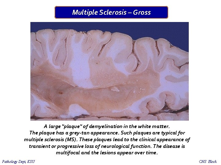 Multiple Sclerosis – Gross A large "plaque" of demyelination in the white matter. The