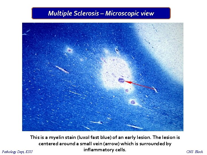 Multiple Sclerosis – Microscopic view This is a myelin stain (luxol fast blue) of