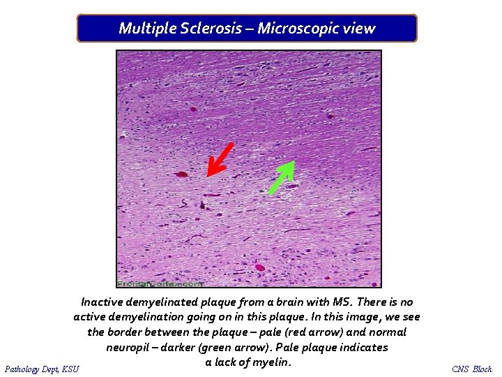 Multiple Sclerosis – Microscopic view Inactive demyelinated plaque from a brain with MS. There