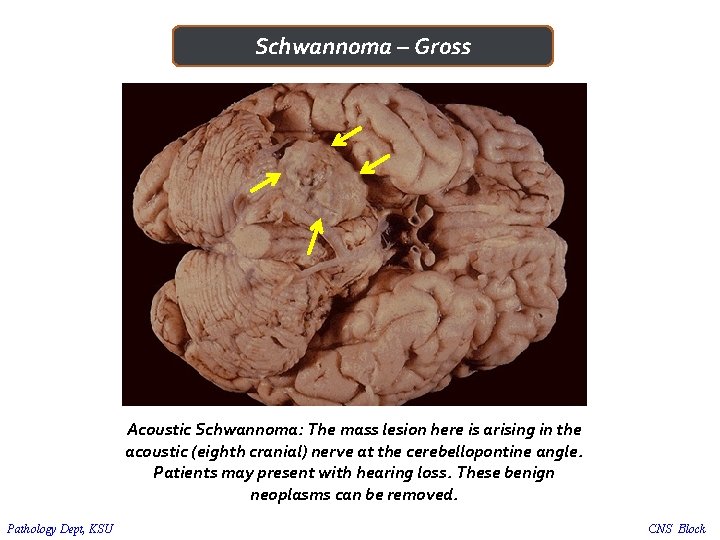 Schwannoma – Gross Acoustic Schwannoma: The mass lesion here is arising in the acoustic