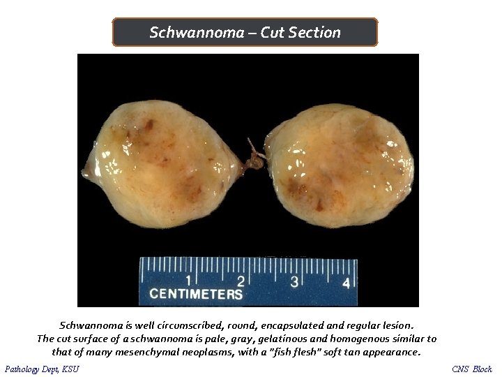 Schwannoma – Cut Section Schwannoma is well circumscribed, round, encapsulated and regular lesion. The