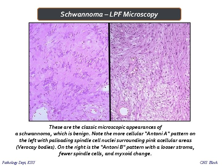 Schwannoma – LPF Microscopy These are the classic microscopic appearances of a schwannoma, which