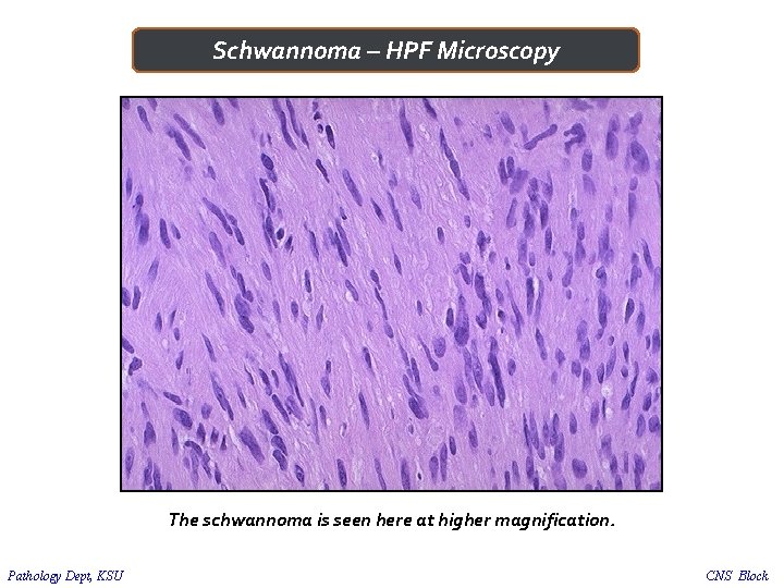 Schwannoma – HPF Microscopy The schwannoma is seen here at higher magnification. Pathology Dept,