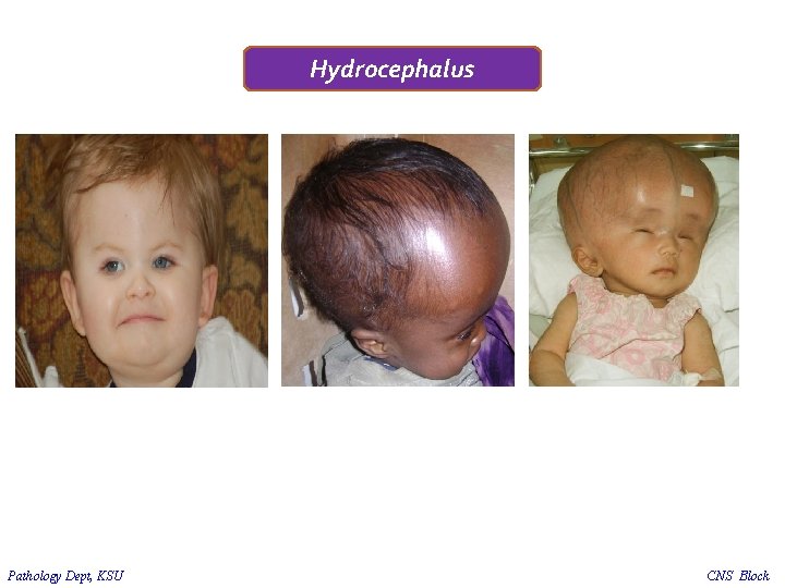 Hydrocephalus Pathology Dept, KSU CNS Block 