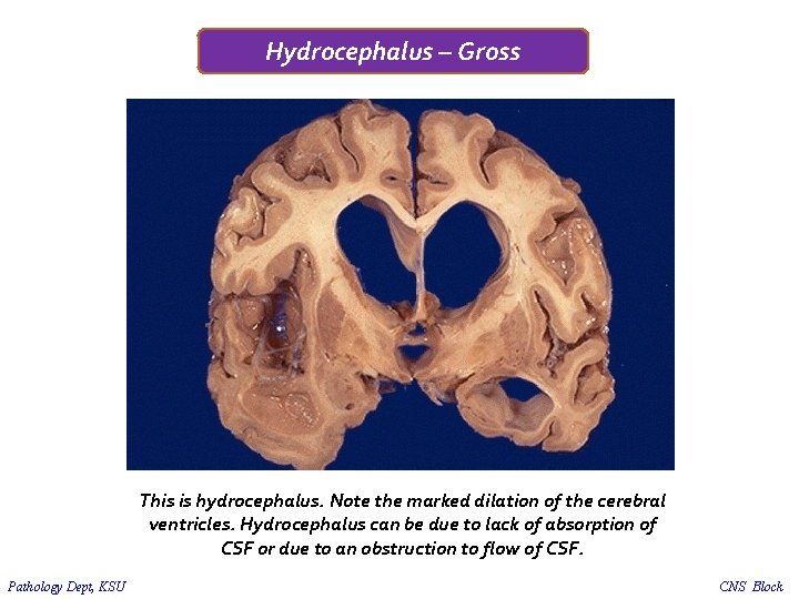 Hydrocephalus – Gross This is hydrocephalus. Note the marked dilation of the cerebral ventricles.