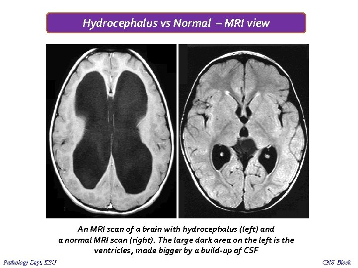 Hydrocephalus vs Normal – MRI view An MRI scan of a brain with hydrocephalus