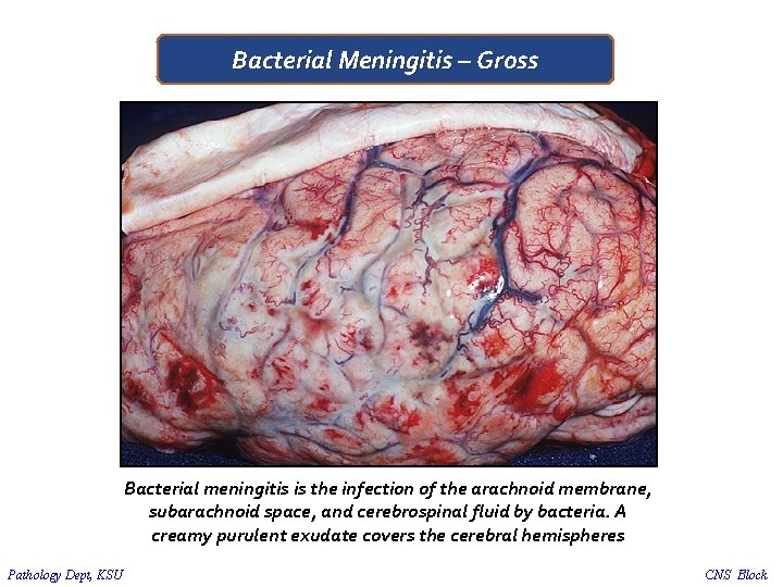 Bacterial Meningitis – Gross Bacterial meningitis is the infection of the arachnoid membrane, subarachnoid