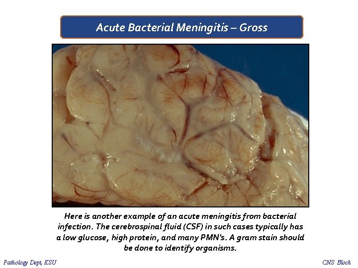 Acute Bacterial Meningitis – Gross Here is another example of an acute meningitis from