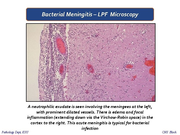 Bacterial Meningitis – LPF Microscopy A neutrophilic exudate is seen involving the meningees at