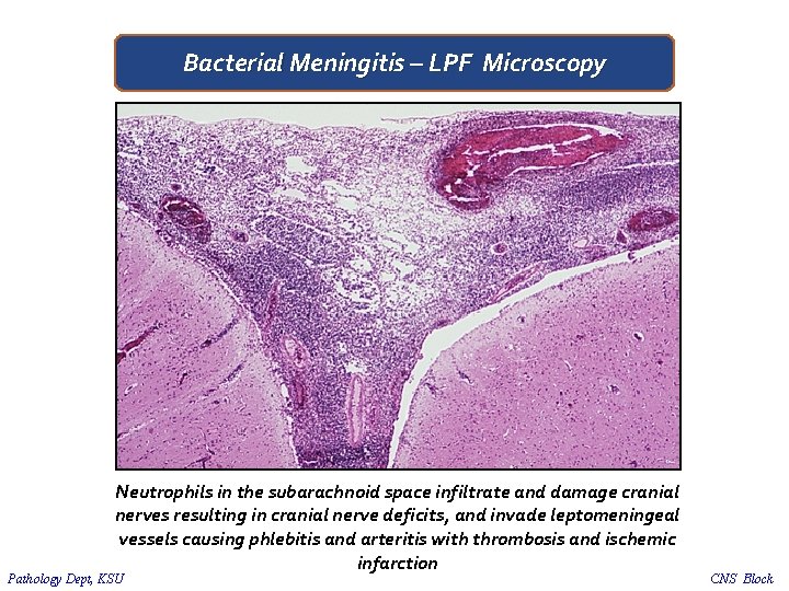 Bacterial Meningitis – LPF Microscopy Neutrophils in the subarachnoid space infiltrate and damage cranial