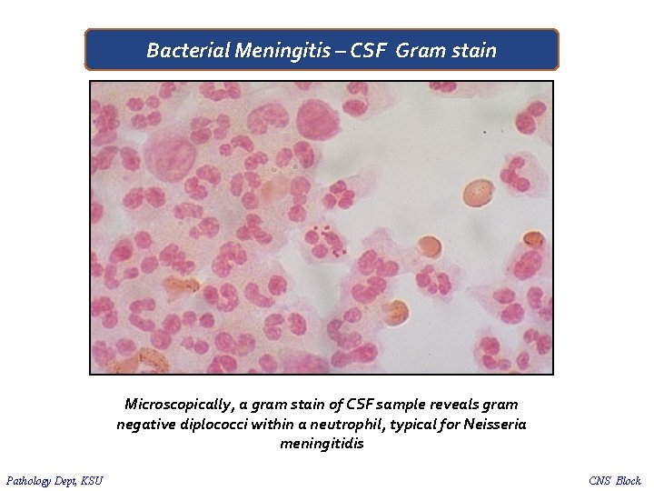 Bacterial Meningitis – CSF Gram stain Microscopically, a gram stain of CSF sample reveals