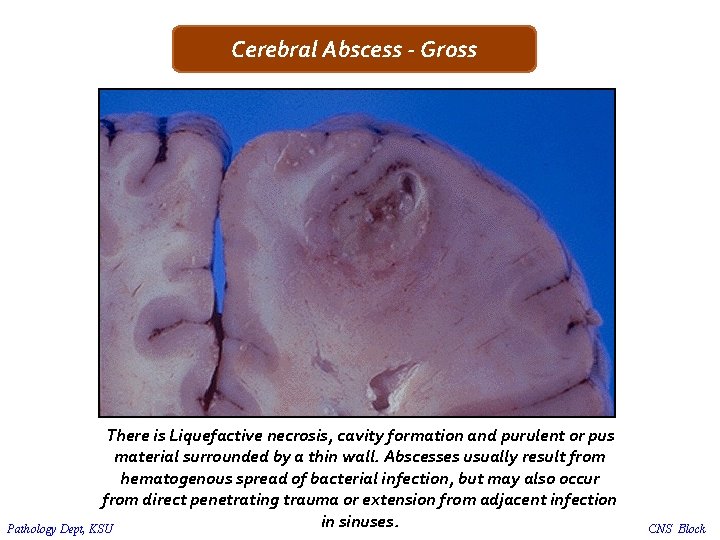 Cerebral Abscess - Gross There is Liquefactive necrosis, cavity formation and purulent or pus