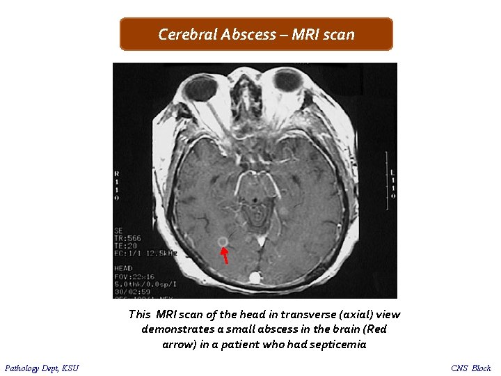 Cerebral Abscess – MRI scan This MRI scan of the head in transverse (axial)