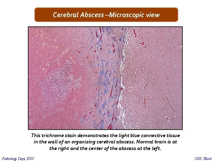Cerebral Abscess –Microscopic view This trichrome stain demonstrates the light blue connective tissue in