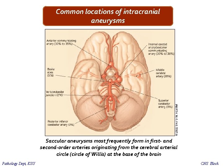 Common locations of intracranial aneurysms Saccular aneurysms most frequently form in first- and second-order